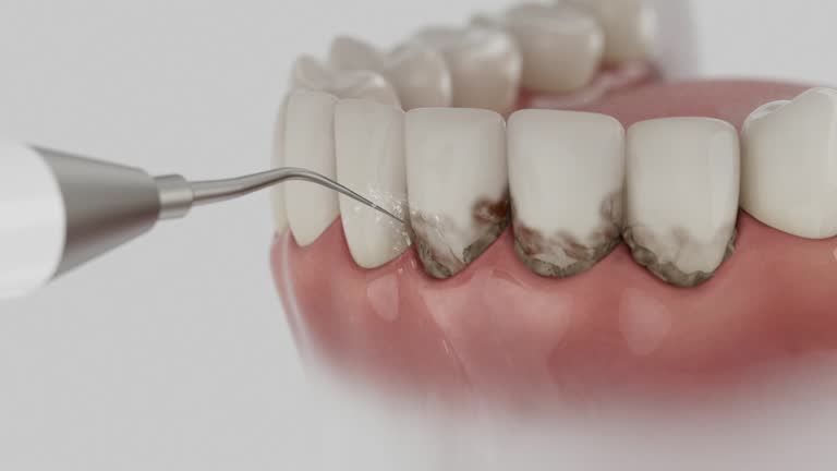 Trusted Wisdom Tooth Removal service in Surf City, NC - Dentist Open Now